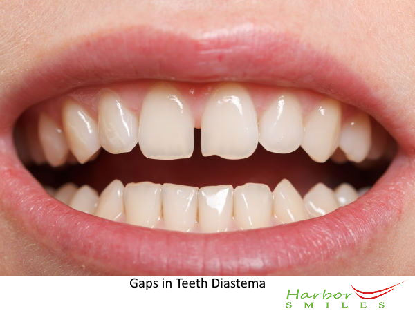 How to Fill Gaps Between Teeth: Your Guide to Diastema