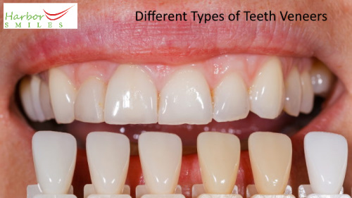 Different Types of Teeth Veneers