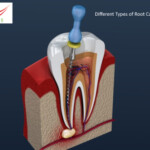 What are the Different Types of Root Canal?