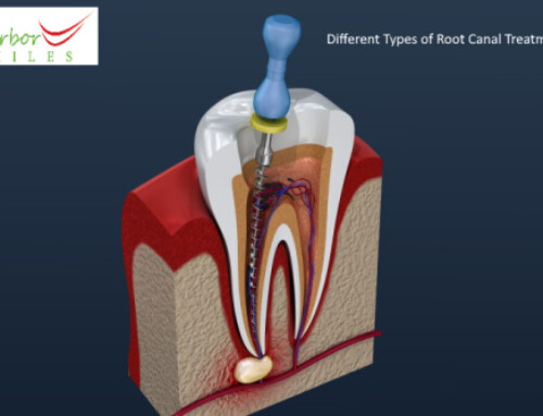 What are the Different Types of Root Canal?