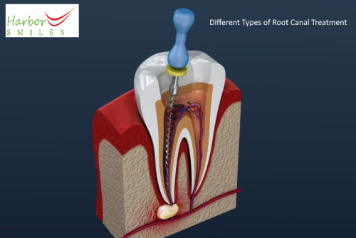 Root Canal Therapy South Huntington NY - Endodontic Treatment